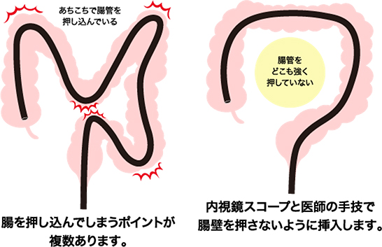 痛みや不快感を最小限にする無送気軸保持短縮法
